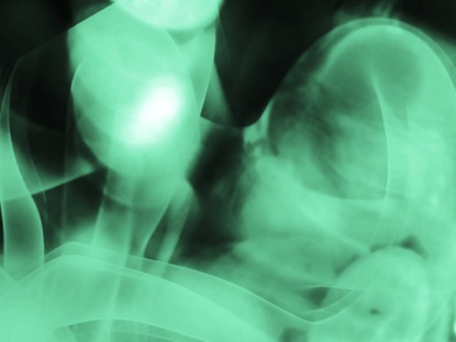 X RAY